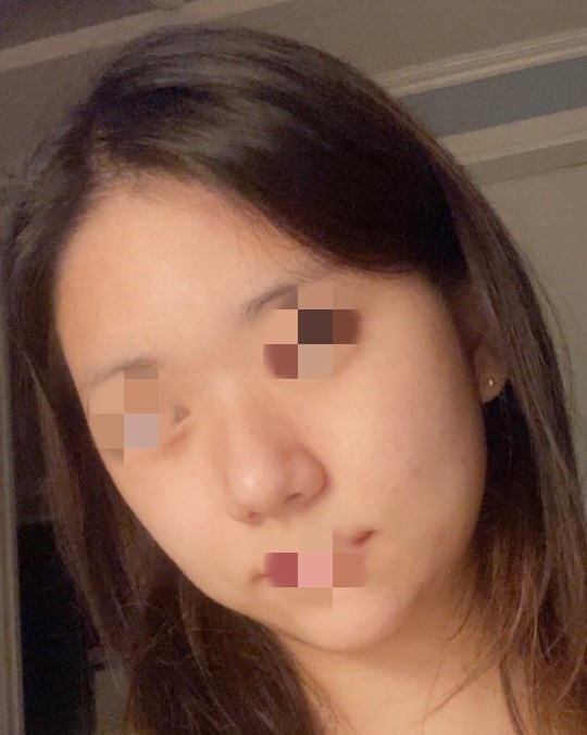 [輪郭手術] アイシャー - 輪郭、鼻、顔の脂肪吸引