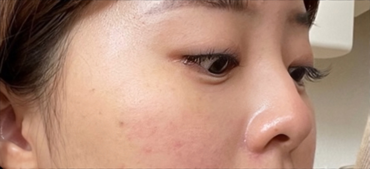 [鼻] ミョンミョン - 鼻