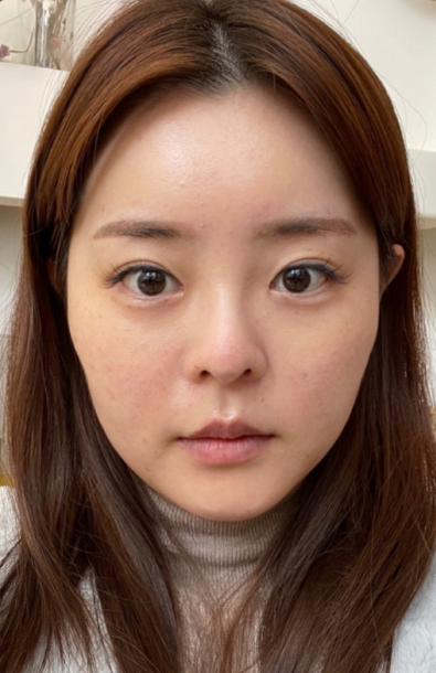 [目] ト끼야 - 目、鼻、輪郭、顔の脂肪吸引