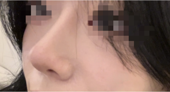 [鼻] ガラスの破片 - 鼻