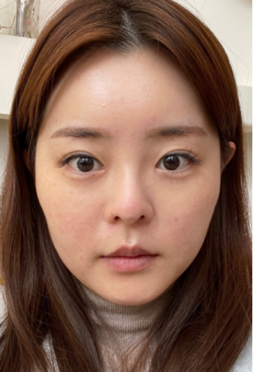 [鼻] ミンアミンオ - 目、鼻、顔の脂肪吸引