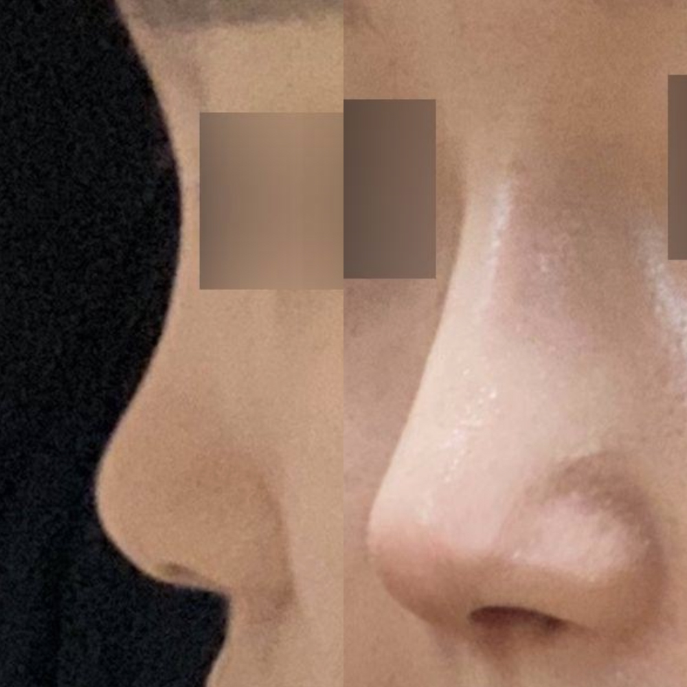 鼻の初手術をウィーバースで受けました