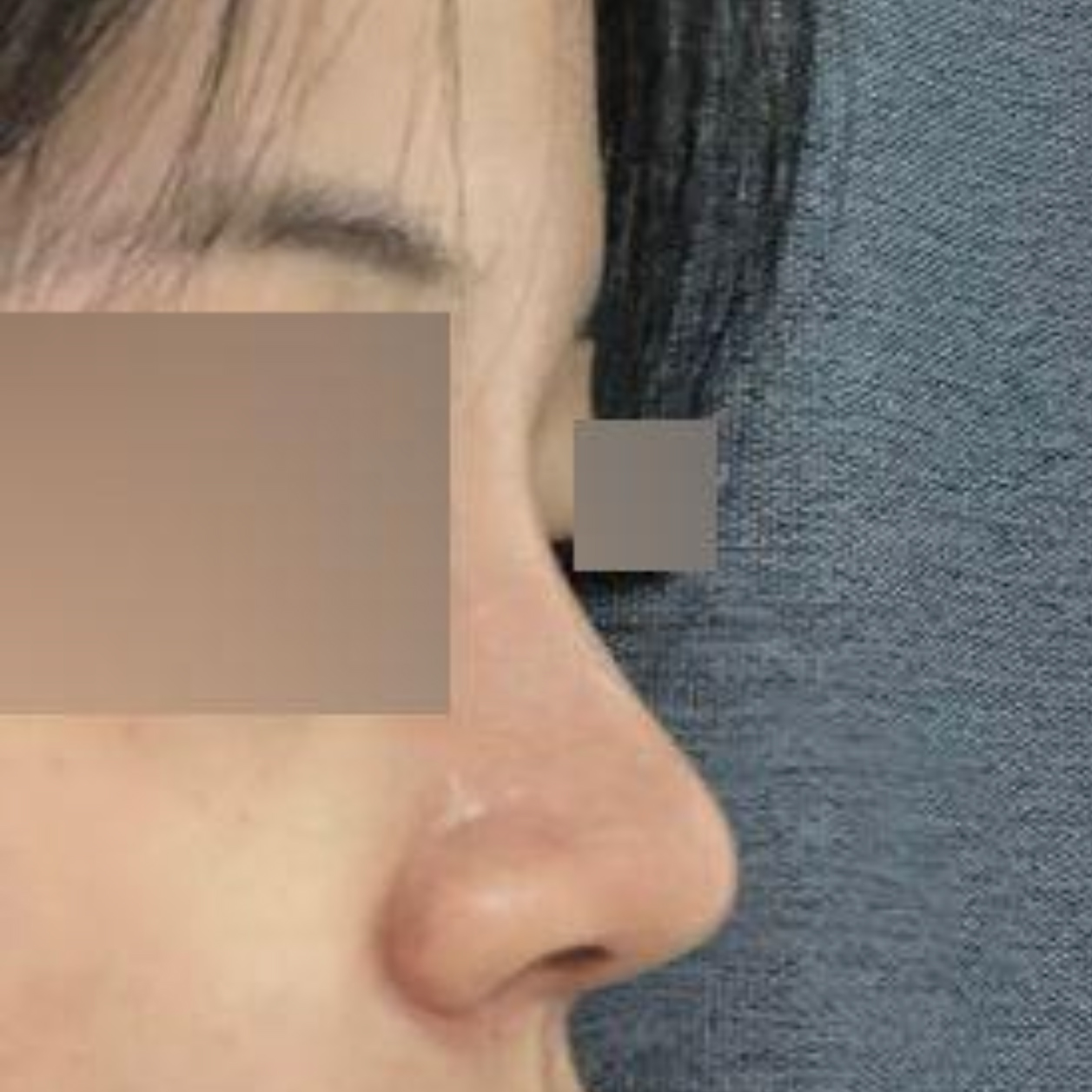 ウィーバース美容外科 鼻手術 1ヶ月目