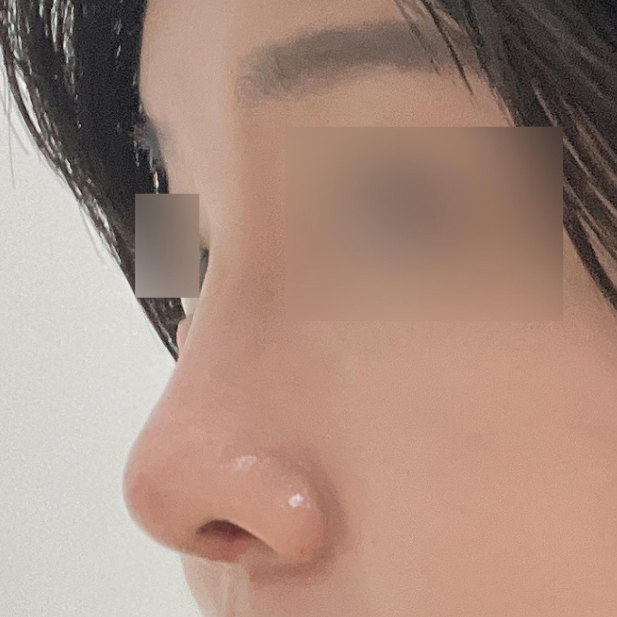アップノーズ手術を受けました~! 