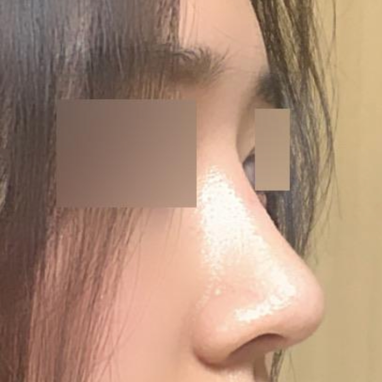 非対称、団子鼻矯正をしました