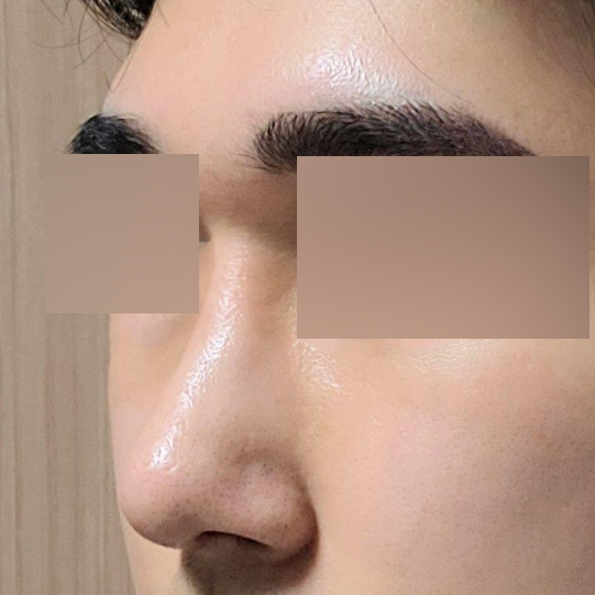 鼻の手術後1ヶ月目のレビューです