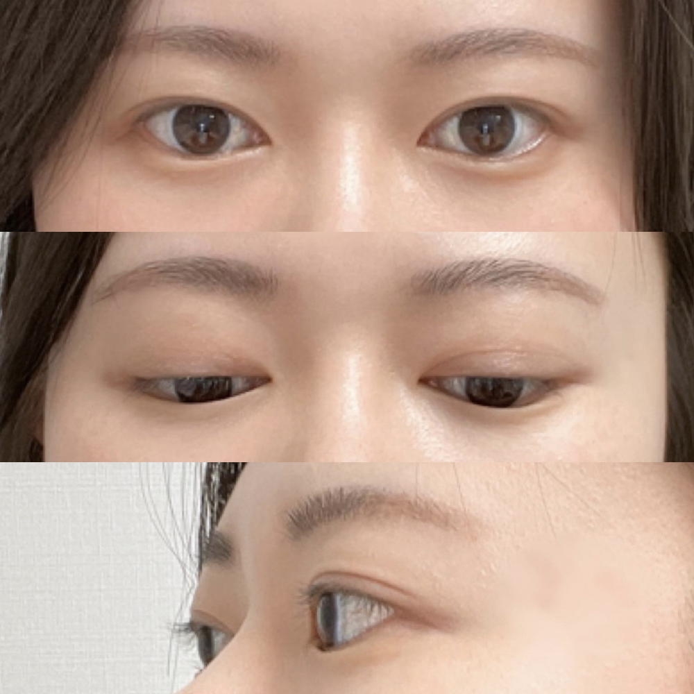 埋没、目つき矯正のレビュー