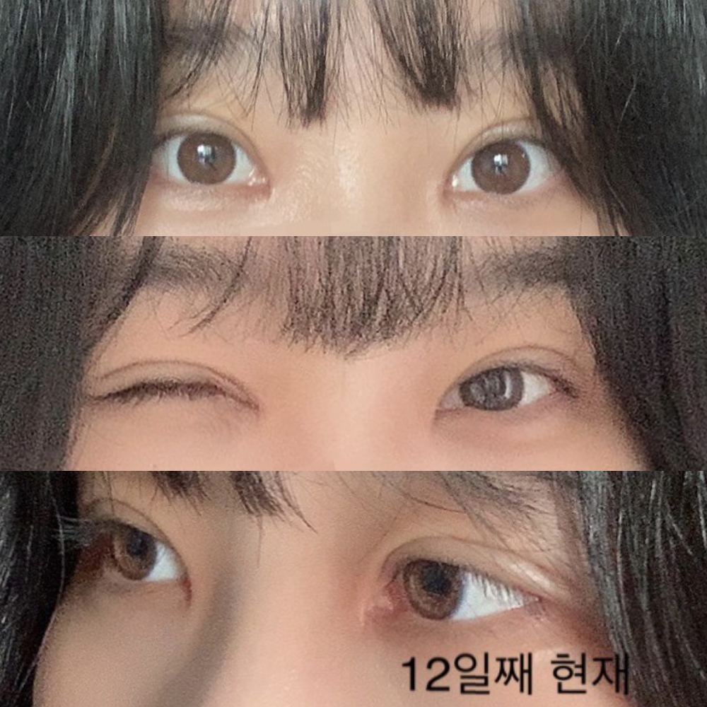 目の再手術、大満足のリアルレビュー