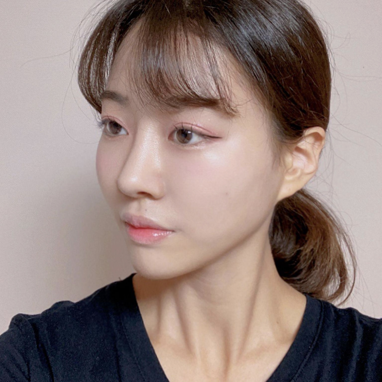 ウィーバース美容外科で鼻の再手術を受けてから2ヶ月経ちました