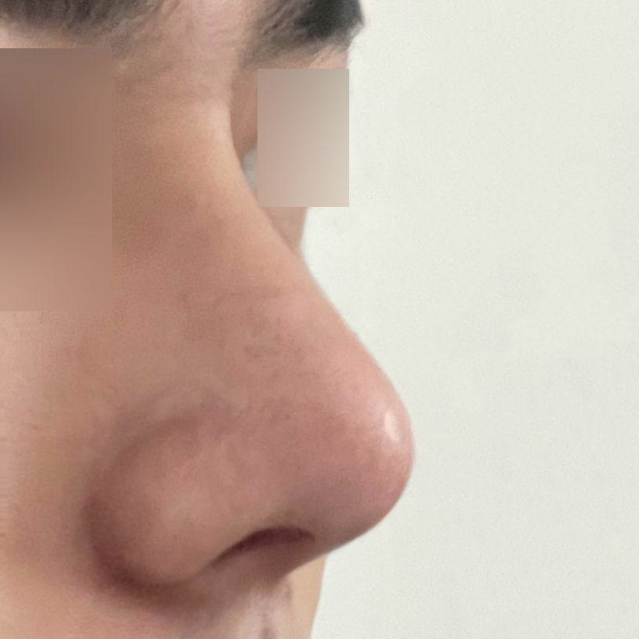 シム・ジョンファン院長に手術を受けてから1ヶ月になりました。