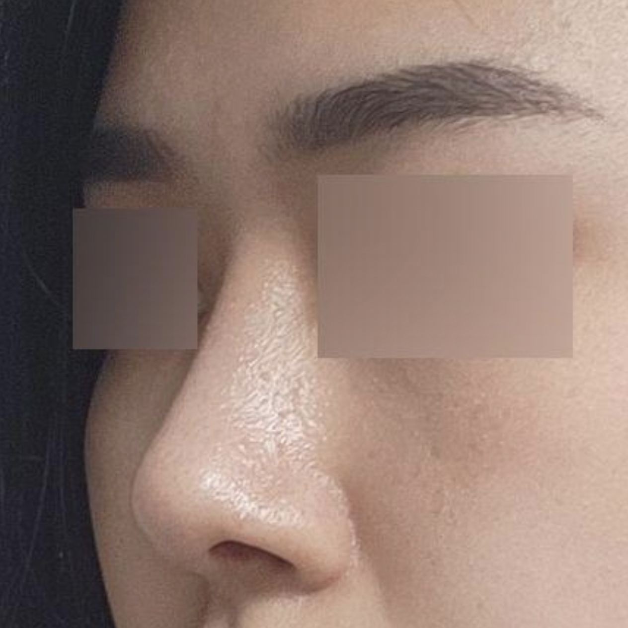 小鼻縮小手術から2ヶ月経ちました！