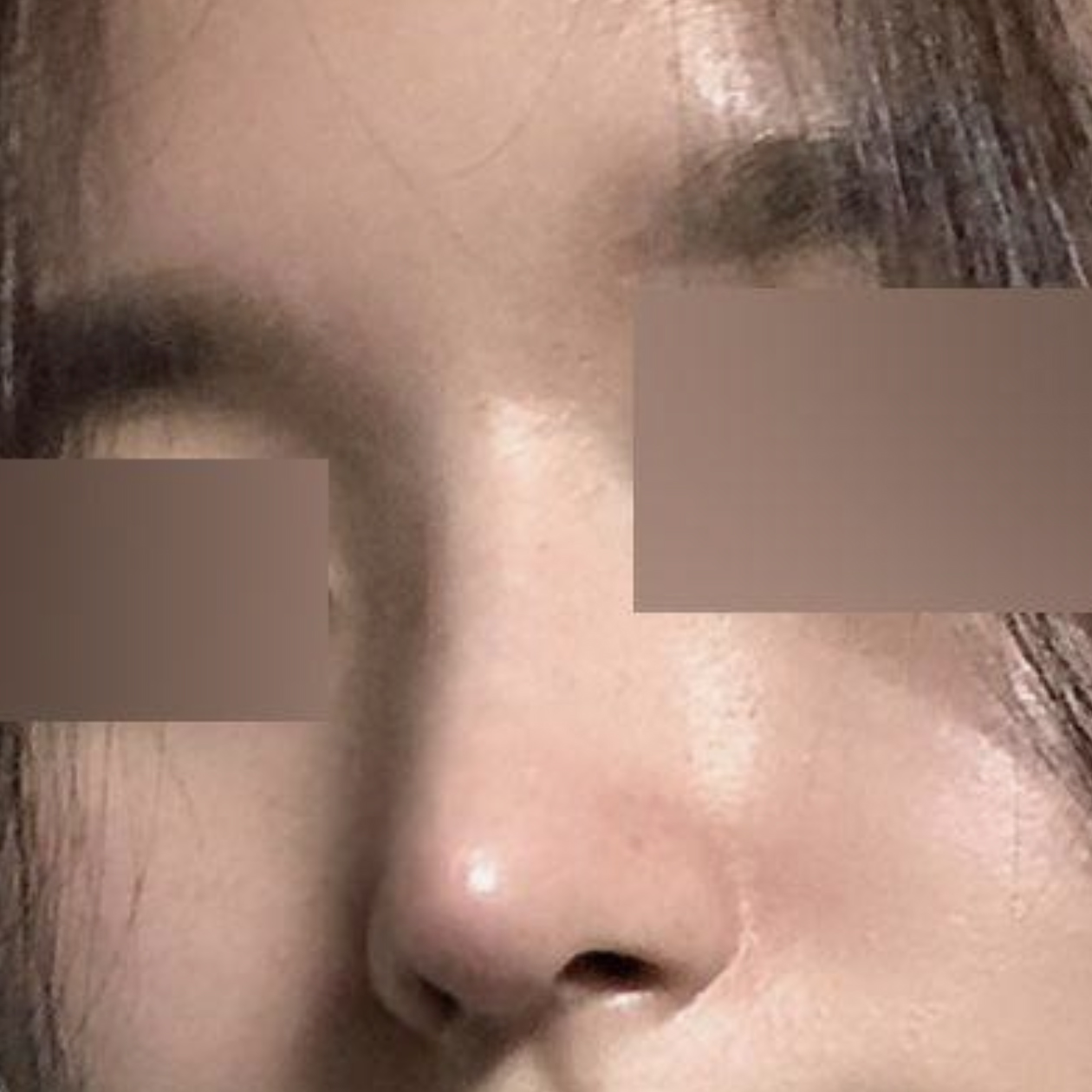 直線的なラインで手術して2ヶ月になりました