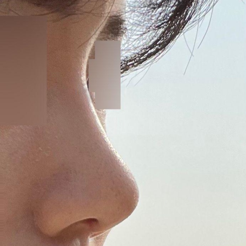 今日ついに内側の抜糸をしてきました！