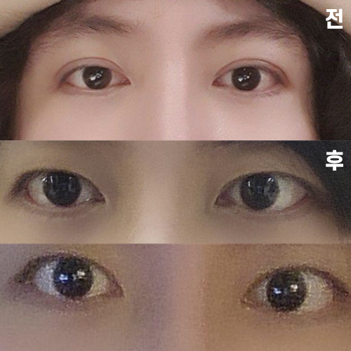 二重ライン修正手術後の経過