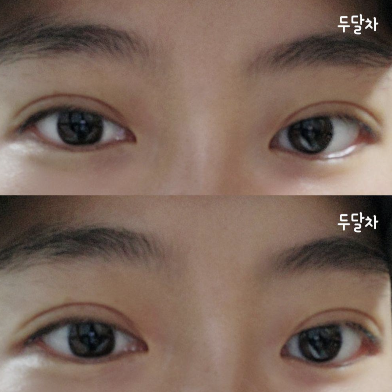 二重手術から2ヶ月後のリアルなレビューです～^^