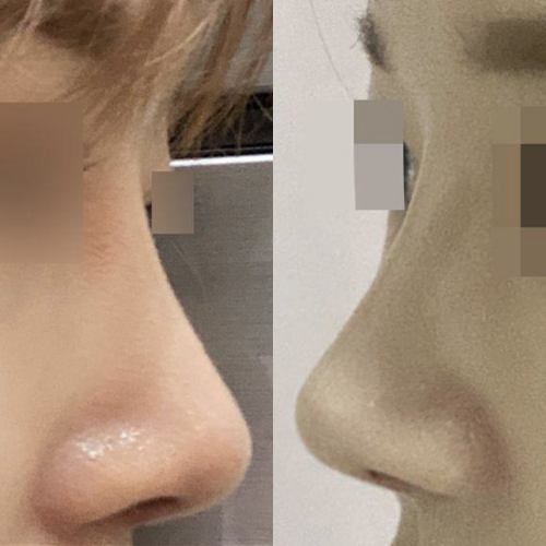 鼻の手術を受けてからもう3ヶ月経ちました