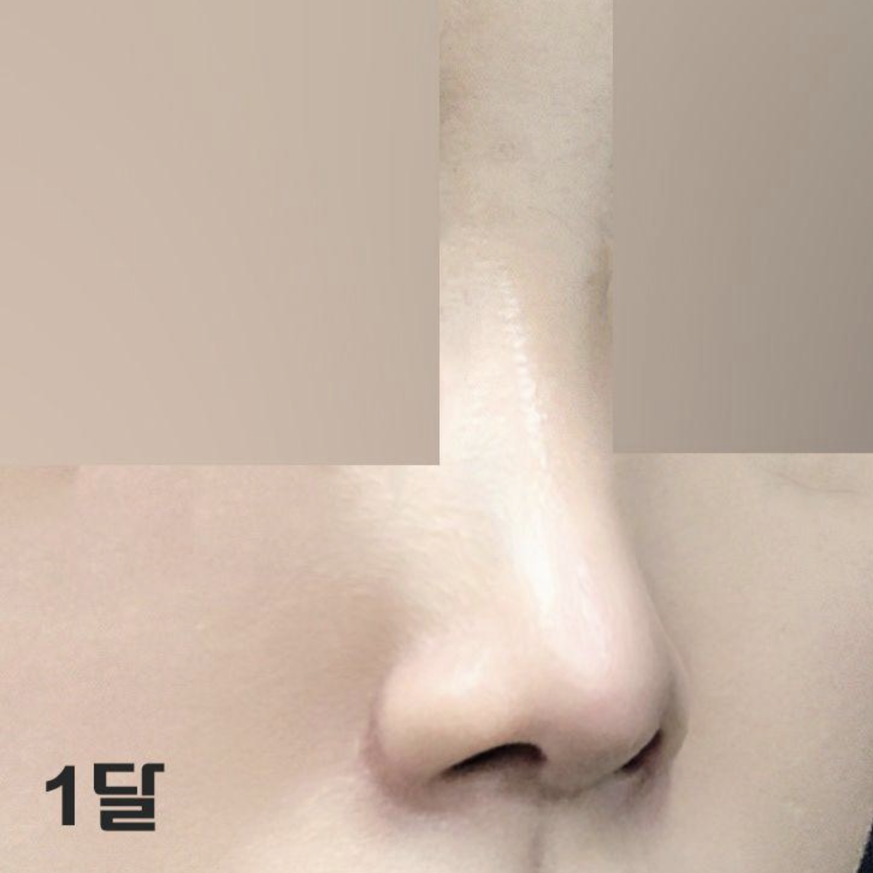 1ヶ月経つと、さらに腫れがどんどん引いていくみたいでーす。