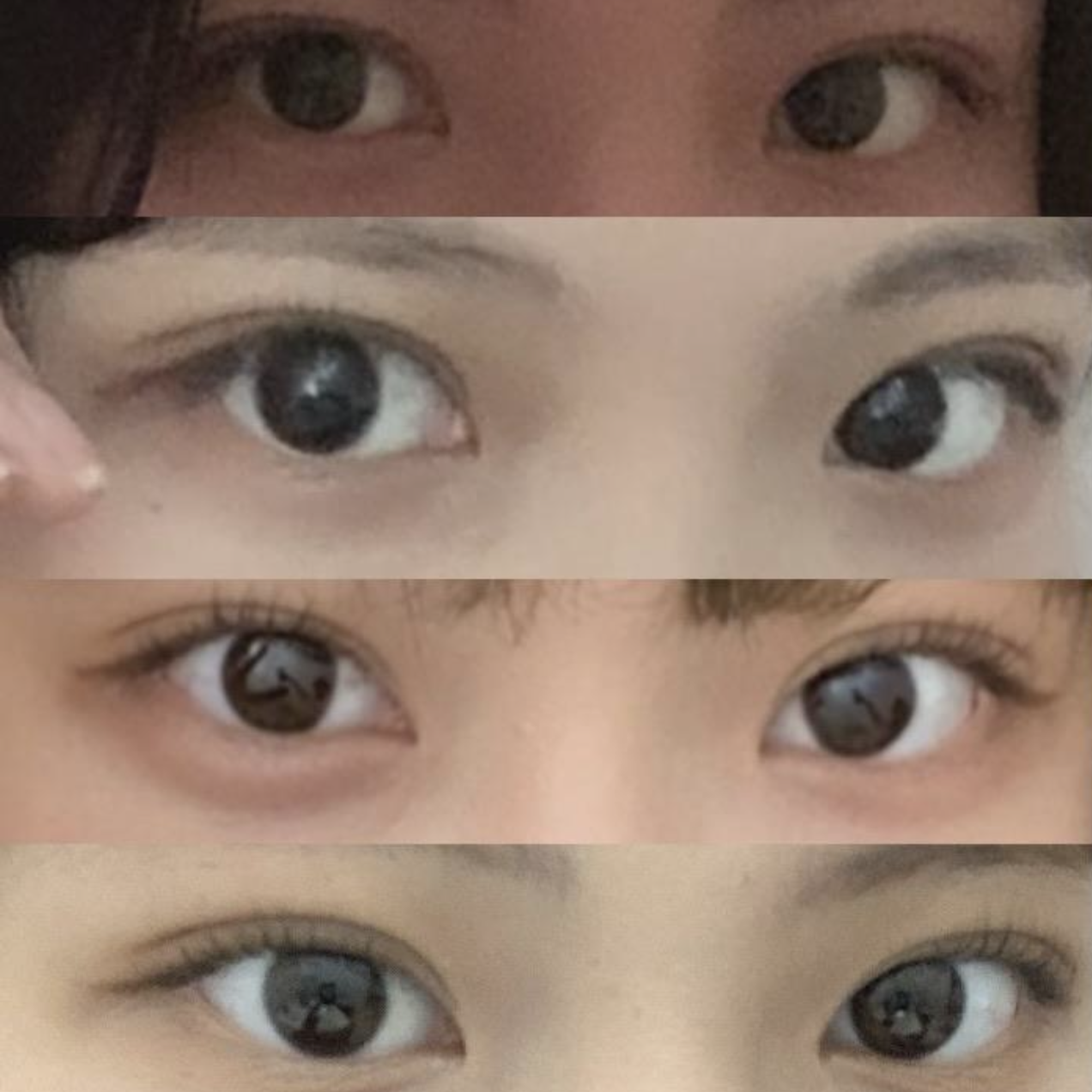 （自然癒着 目つき矯正 目頭切開）手術を受けてから4ヶ月