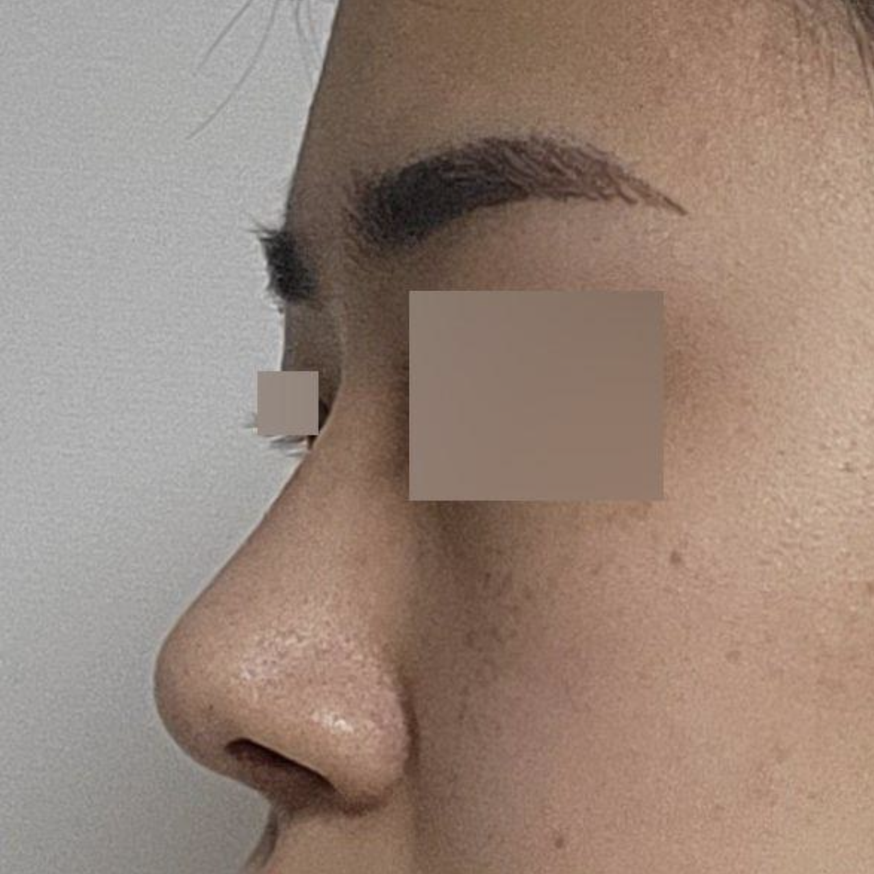 手術して3ヶ月になりました。