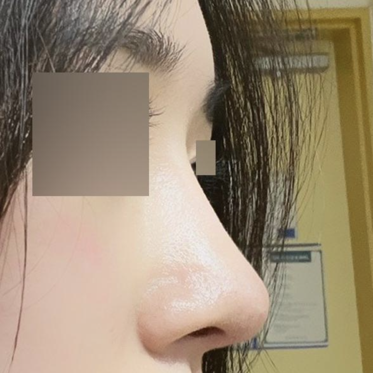 シム・ジョンファン院長に手術を受けて4ヶ月になりました!