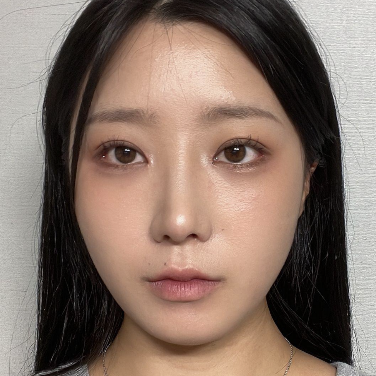 手術して1ヶ月目です〜