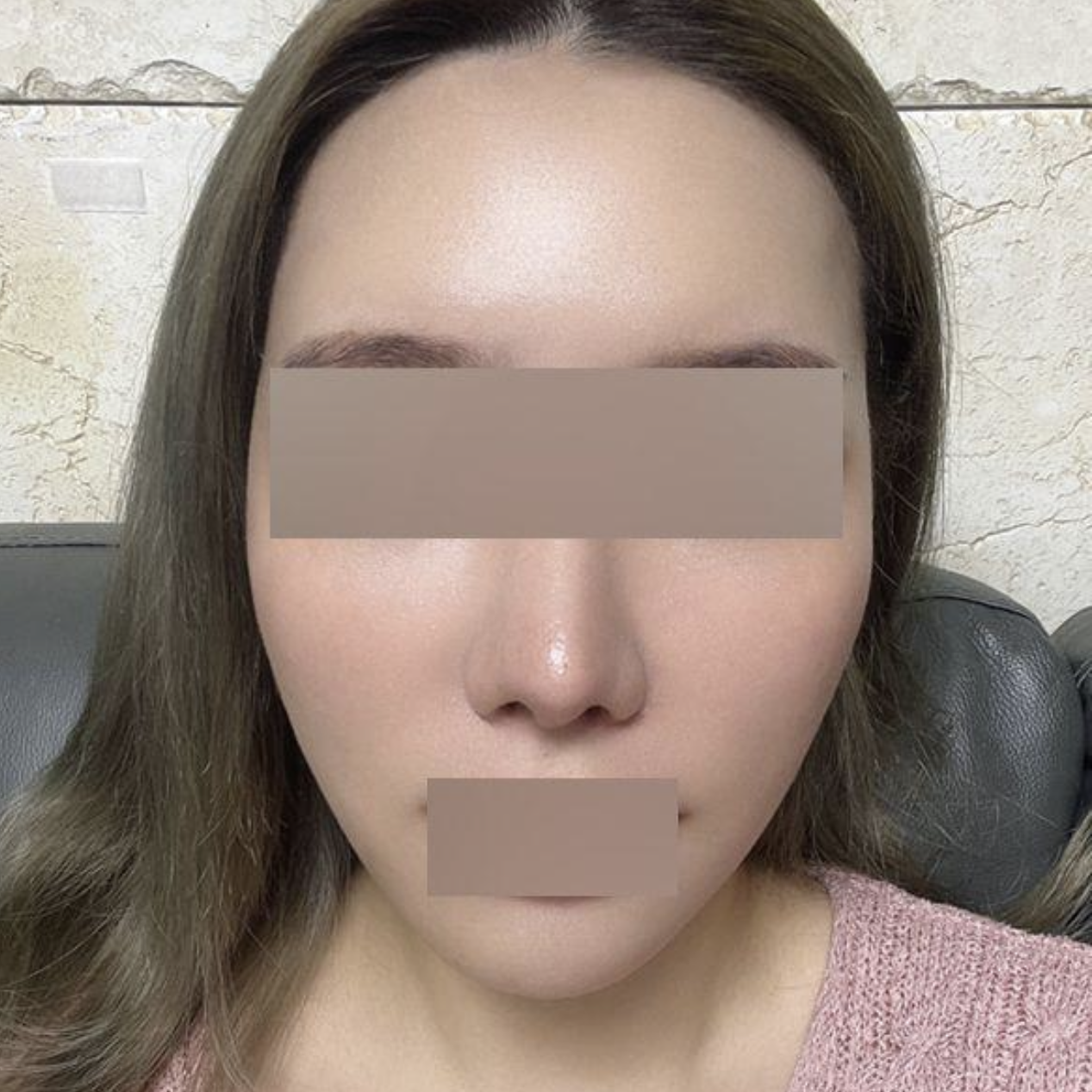 ウィーバースでリフトアップしました。マジでおすすめ