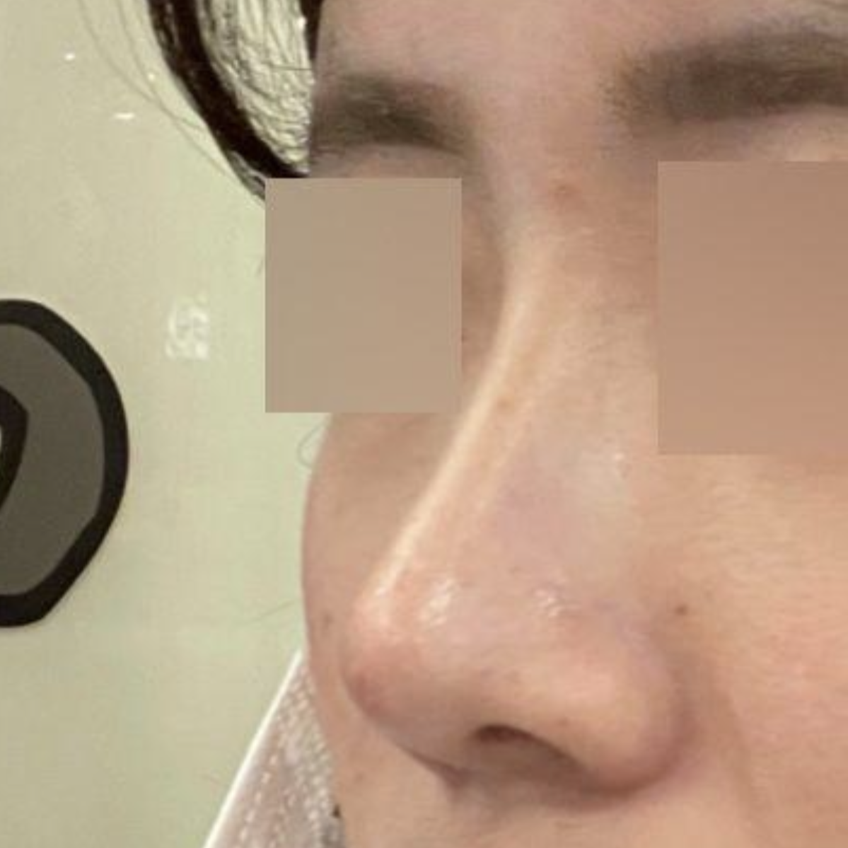 鼻の手術を受けてからもう2ヶ月になりました！