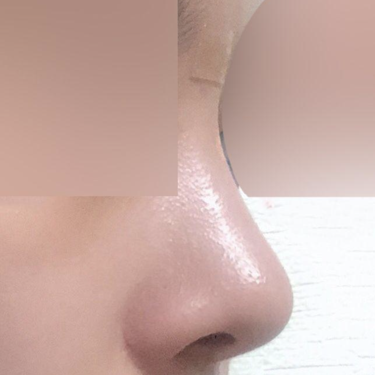 鼻の手術後3ヶ月目のレビュー