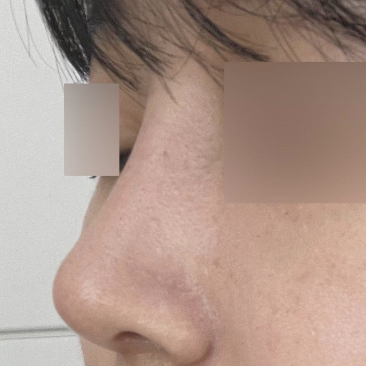 鼻の手術後1ヶ月、成功しました！