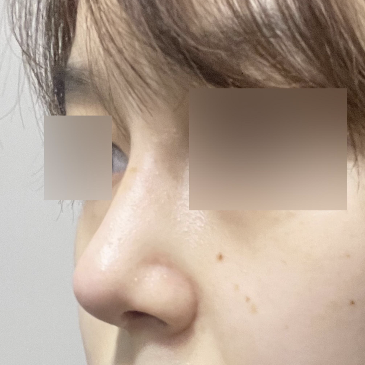 ウィーバース美容外科で鼻再手術を受けて1ヶ月目のレビューです~! 