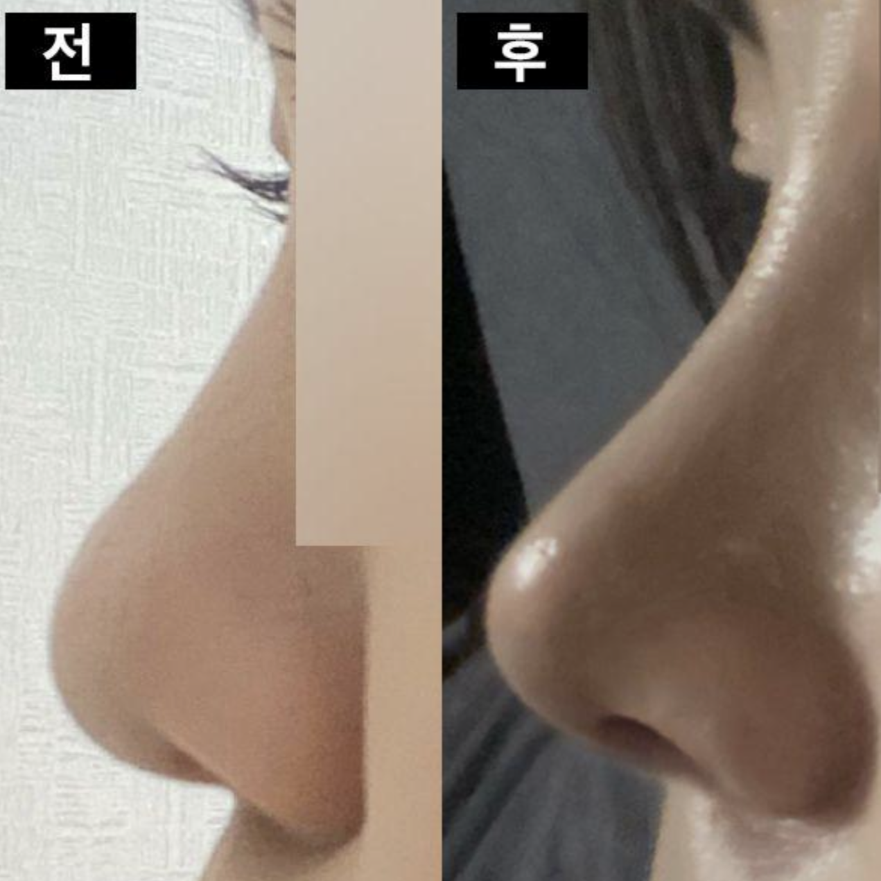 鼻の手術をしてから1ヶ月になりました ㅎ