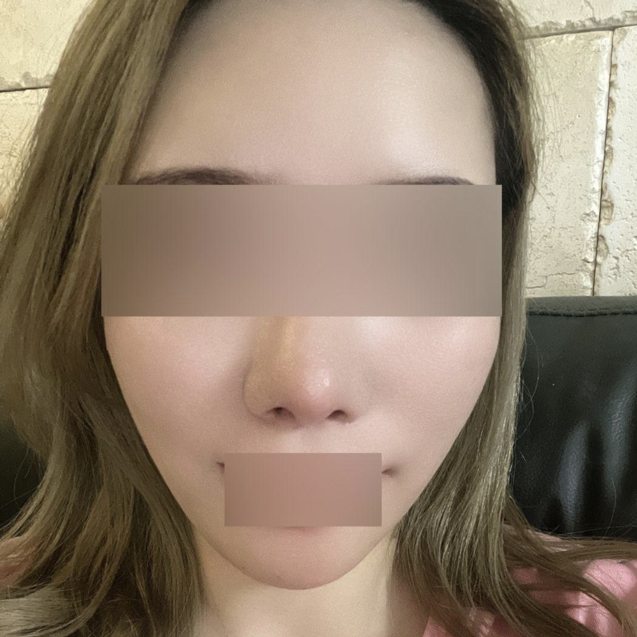 糸リフティングをして2ヶ月経ちました〜