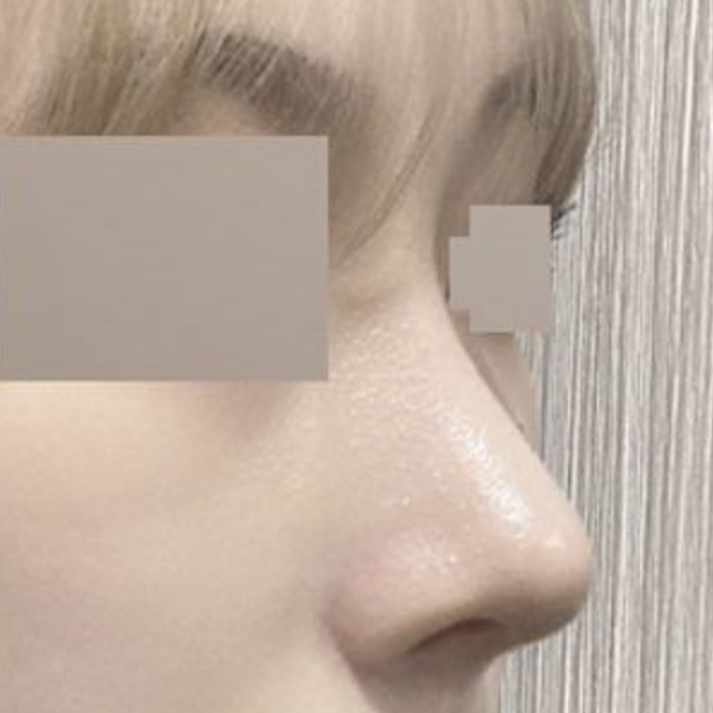 もう手術して2ヶ月になります!!