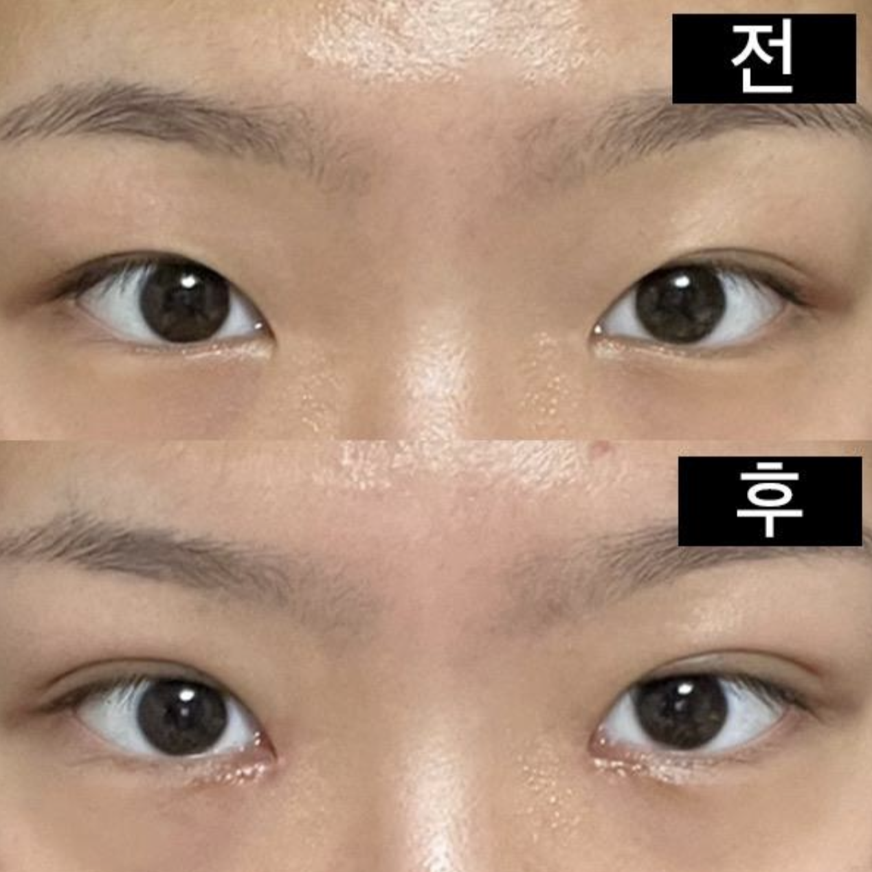 手術前後の写真はすべて基本カメラで撮影しました！