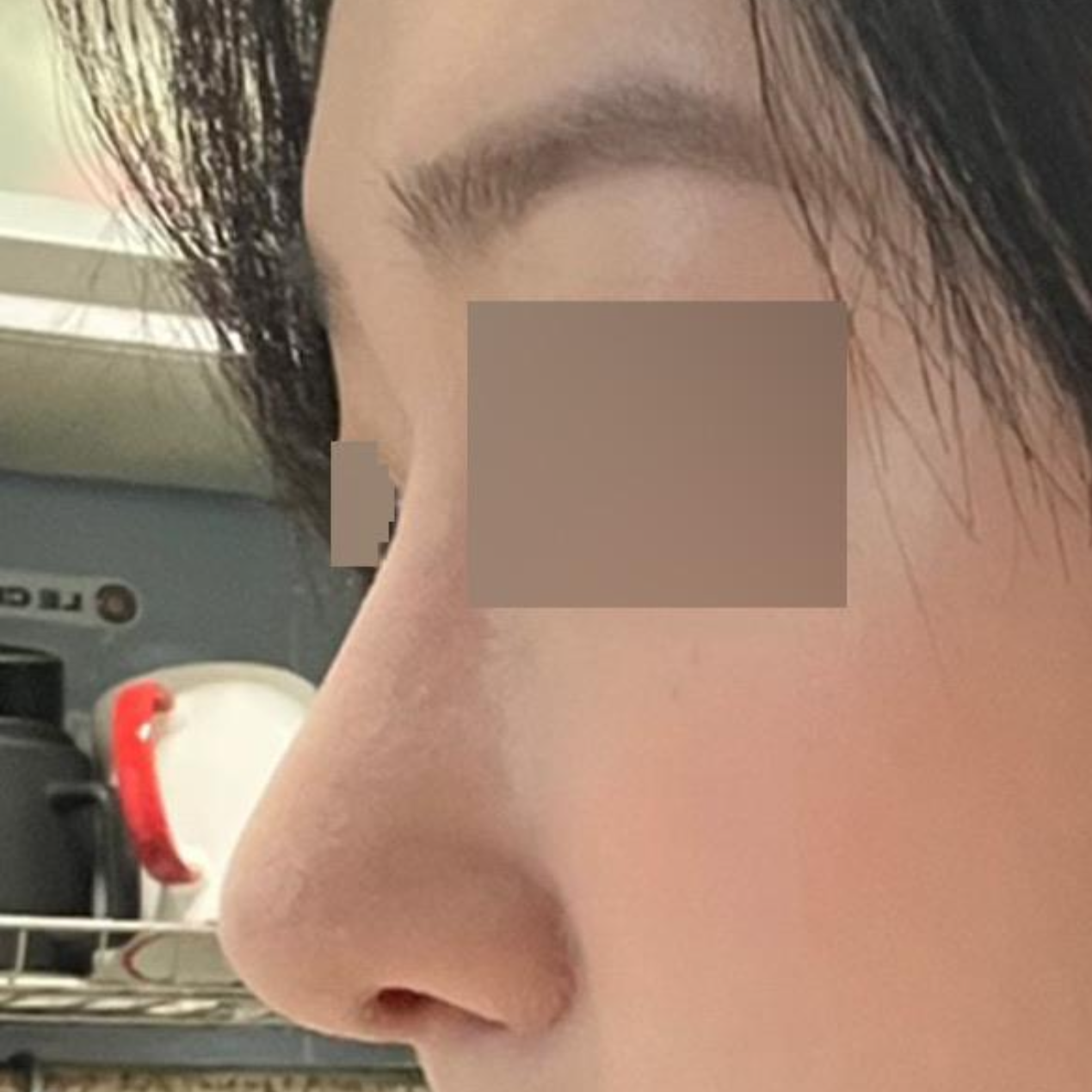 初めての鼻の手術で色々悩んだ末、ついに鼻の手術をしました。