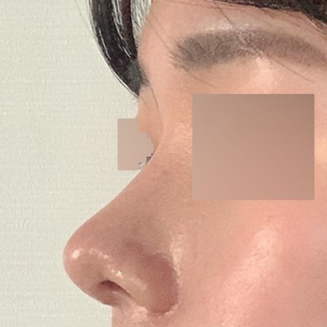 ウィーバース美容外科で目と鼻の手術を受けて1ヶ月後のレビュー!!