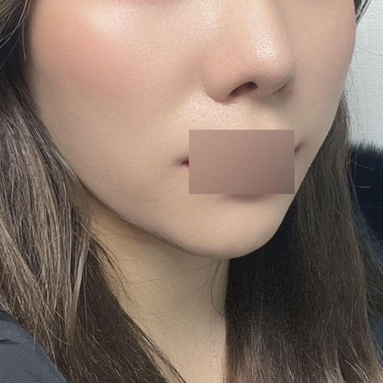 ピーチシルリフティング3ヶ月目になりました