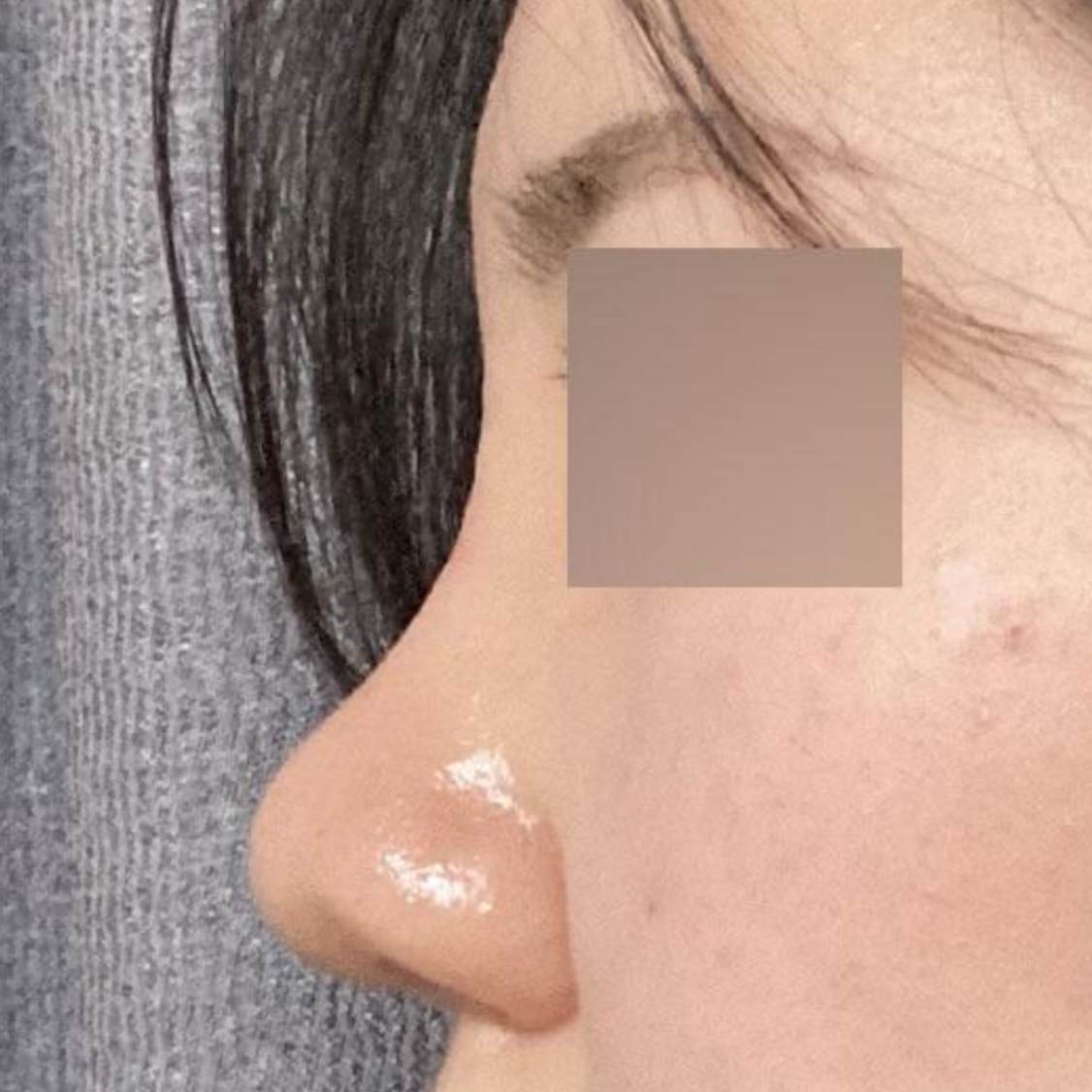 手術後1ヶ月目のレビューです。ウィーバース美容外科のシム・ジョンファン院長に鼻の手術を受けました！