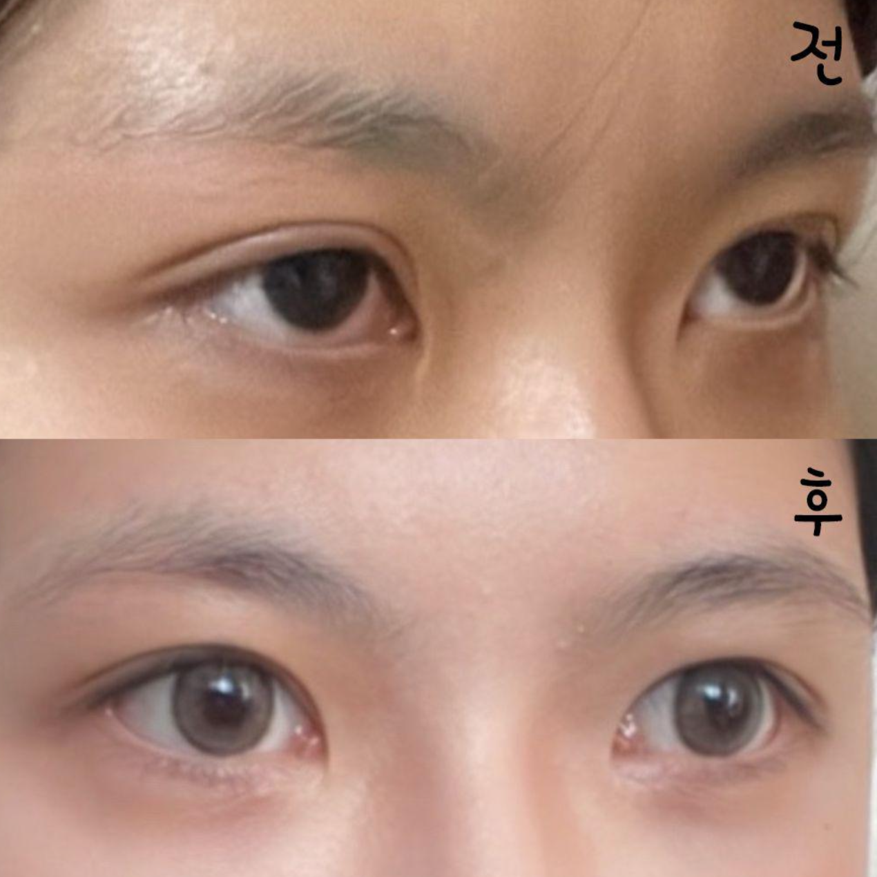 江南駅ウィーバース美容外科で目の再手術をしてから2ヶ月目です！