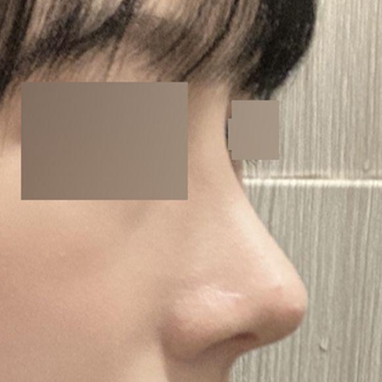 鷲鼻の手術から3ヶ月経ちました！