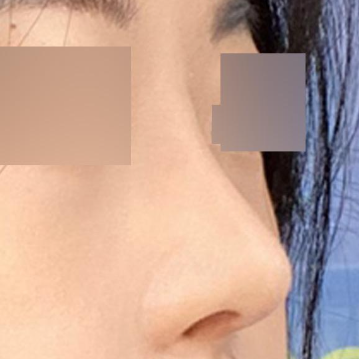 手術後2ヶ月経ちましたが、とても満足しています。