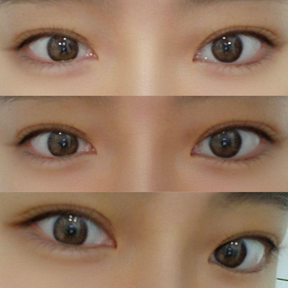 シム・ジョンファン院長に非切開目つき矯正を受けました!