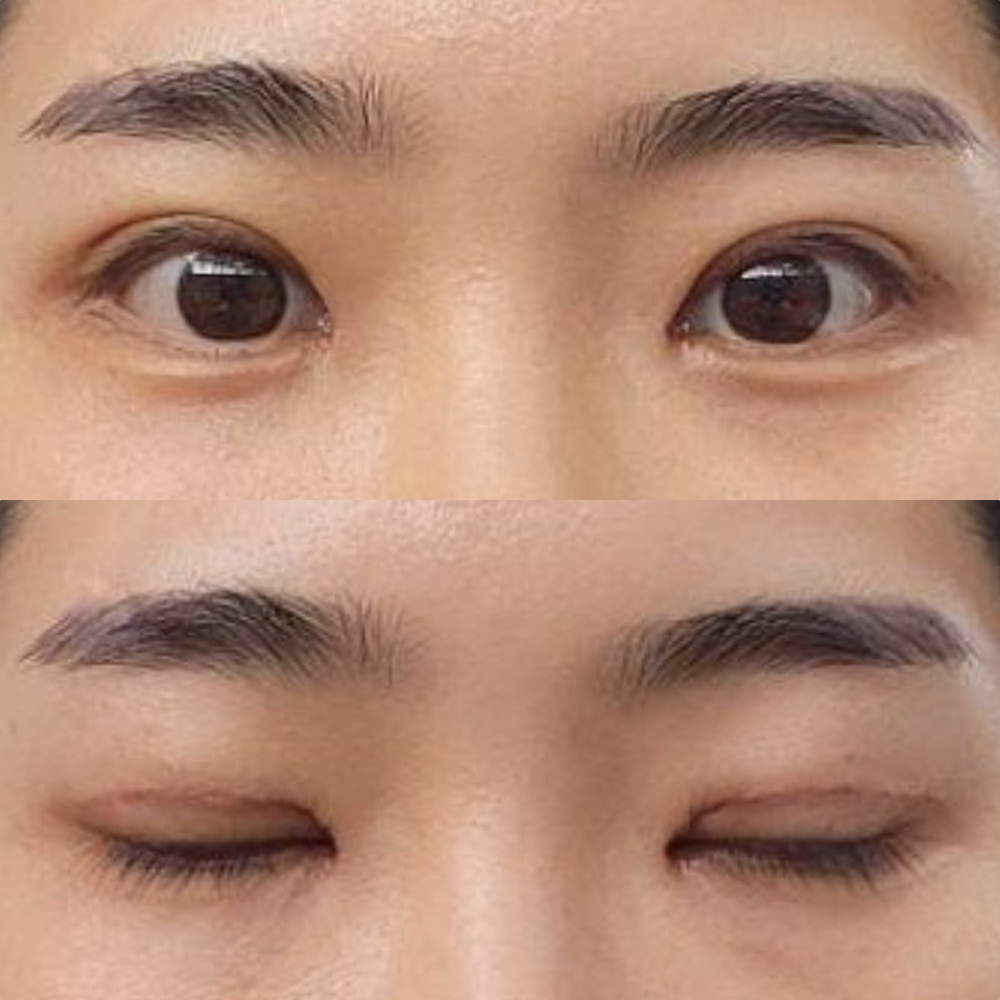 目の再手術を受けてから一週間経ちました