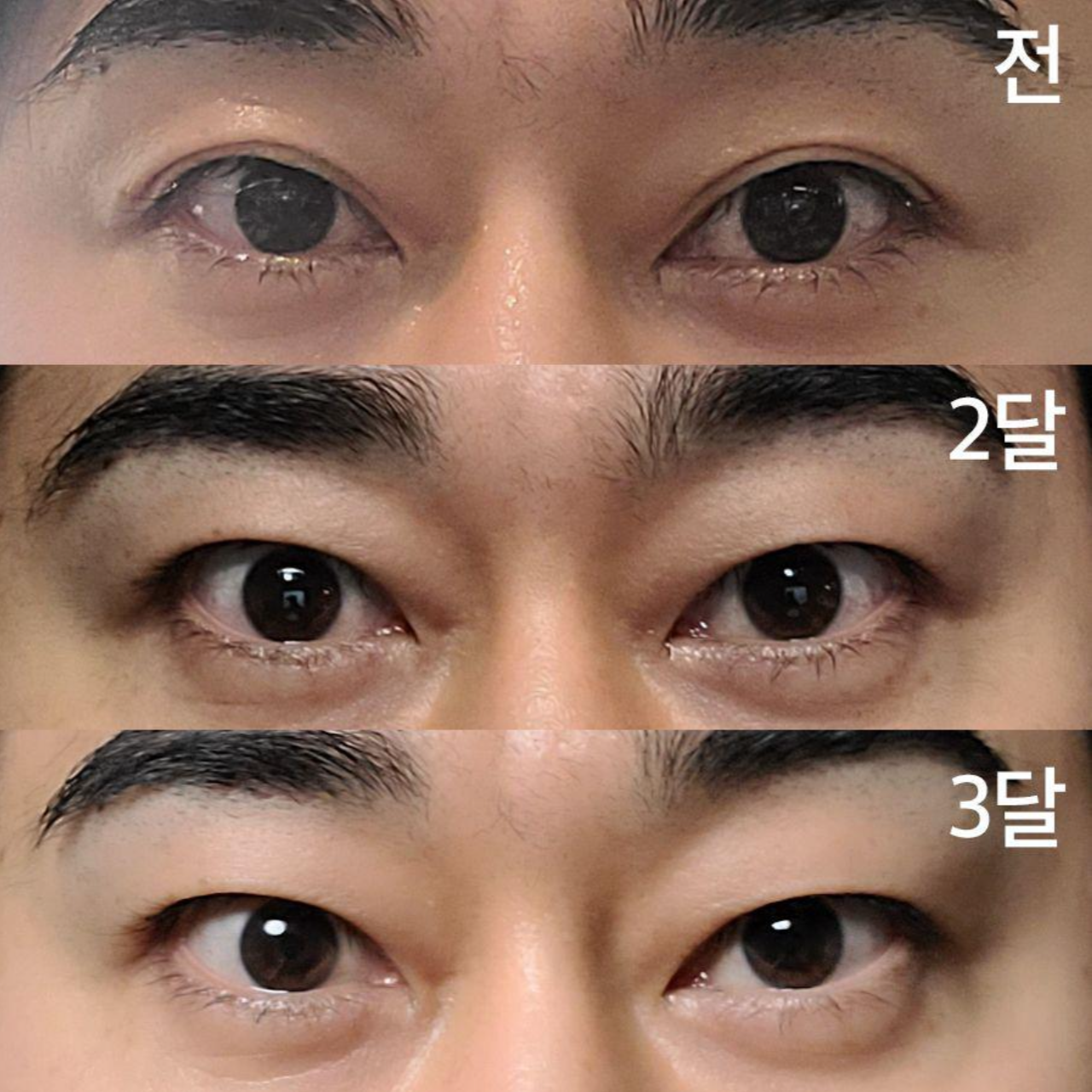 二重まぶた切開手術後3ヶ月目です。