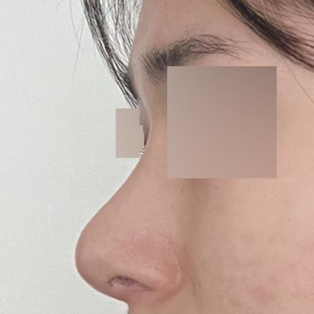 ウィーバース美容外科医院で鼻の手術をしてから2ヶ月目です。