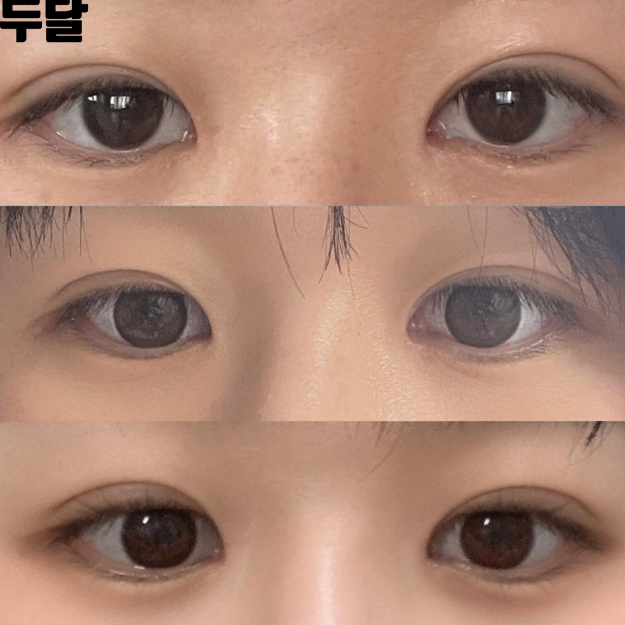 シム・ジョンファン院長に目と鼻の手術を受けてから2ヶ月後のレビューを残します