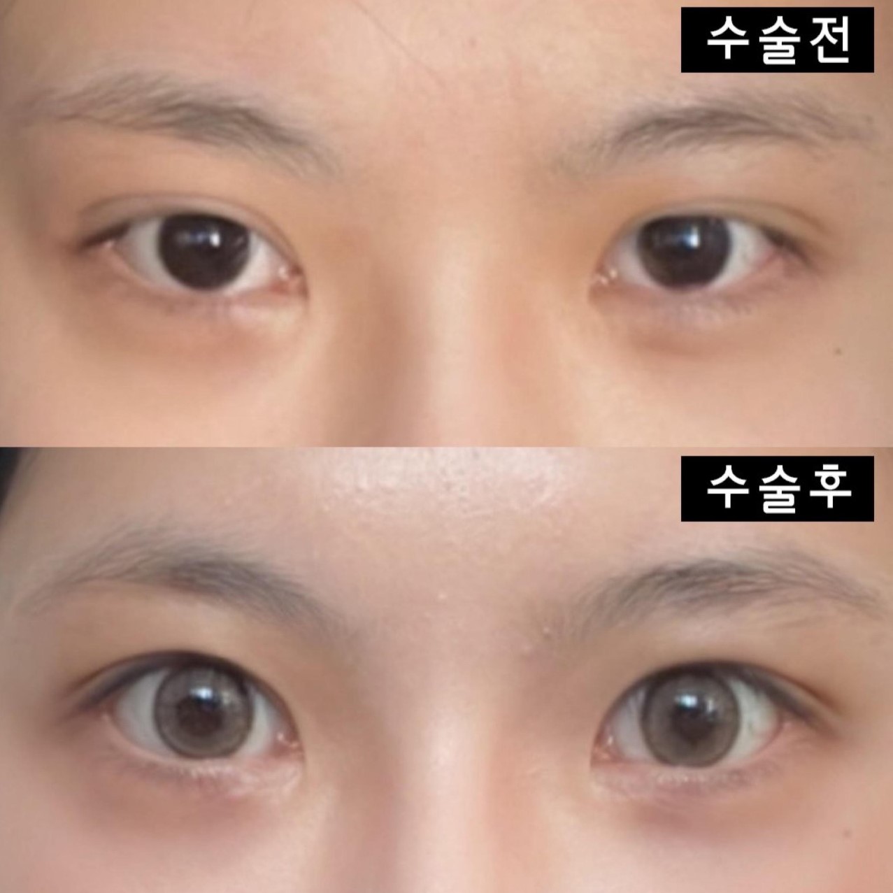 ウィーバース美容外科で手術して2ヶ月目です〜