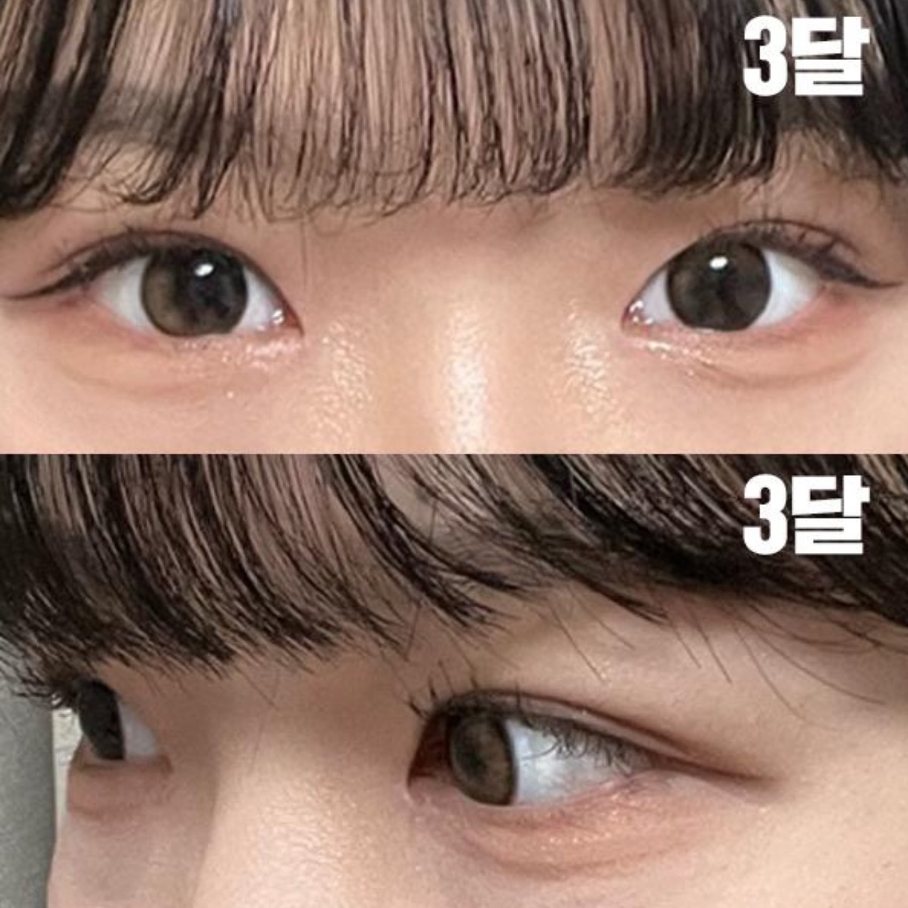 シム・ジョンファン院長にインアウトラインで手術してもらいました。