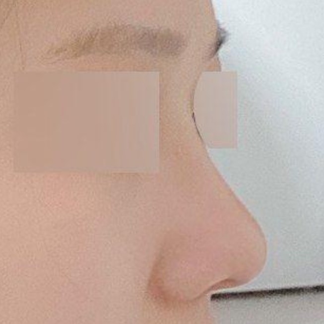 鼻筋ができて横顔も綺麗になり、立体感も生まれました!