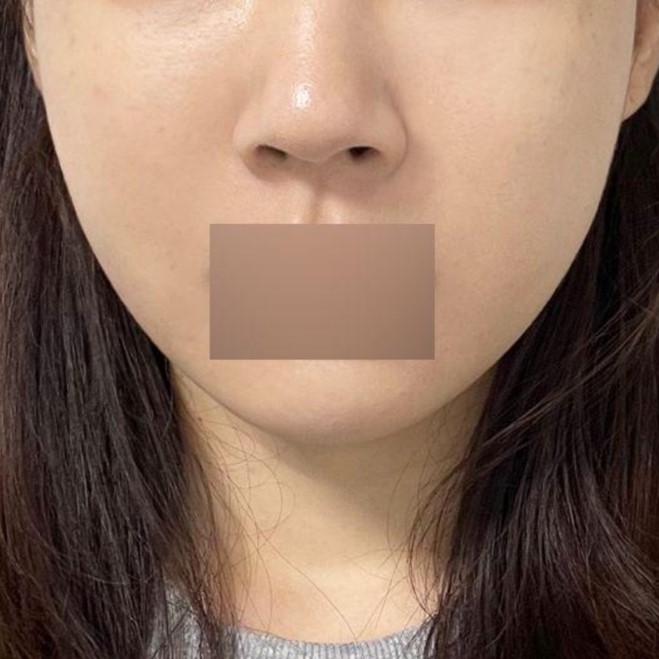 ウィーバース美容外科で糸リフトを受けて1日目です